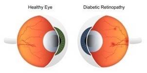 Diabetic Retinopathy